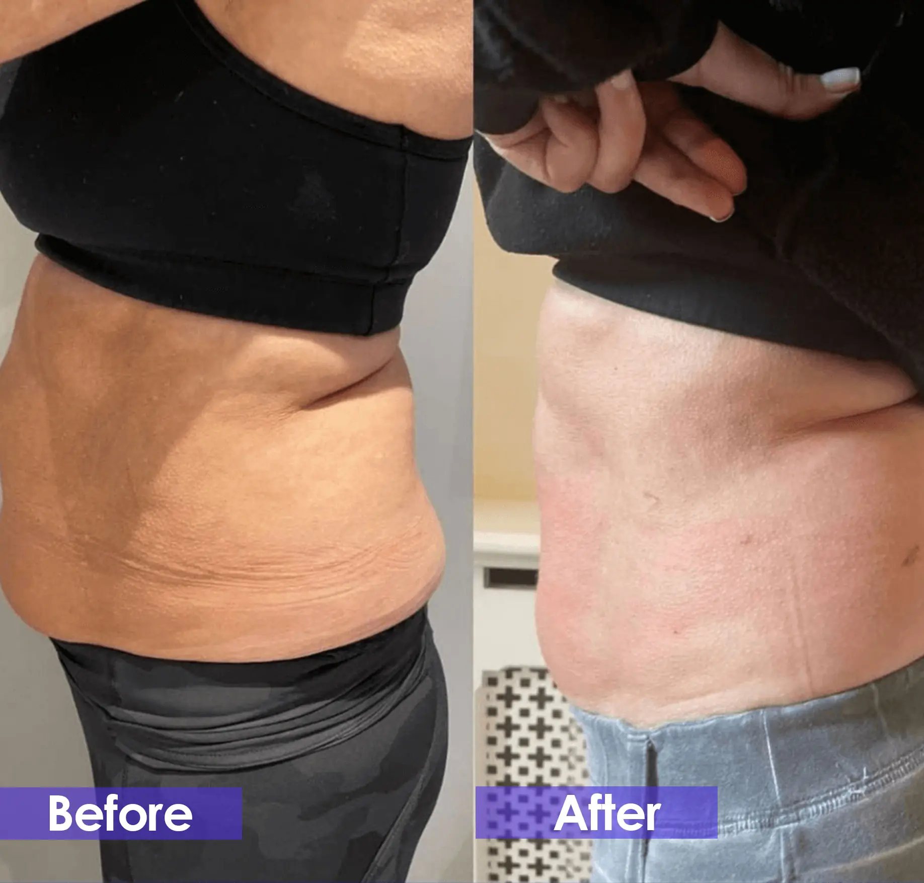 cryolipolysis treatment Before and after:  female abdomen with smaller